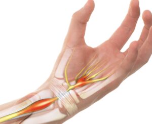 Artist's illustration of the median nerve running under the carpal tunnel and into the hand