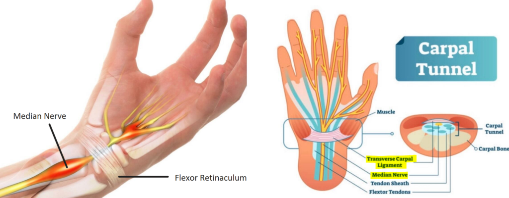 Artists' illustration of the median nerve running under the carpal tunnel and into the hand